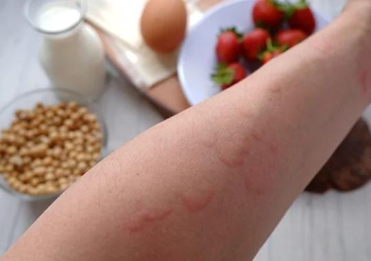 Utility of xMAP For Multiplex Testing, Suspected Allergy, and Potential Cross-Reactivities in Food Samples (Food Testing)